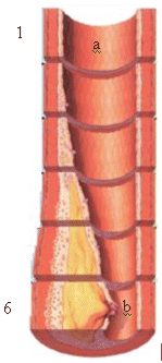 Stena arterije
